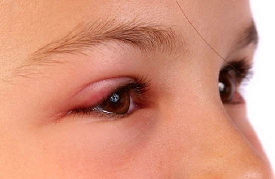 Lựa chọn cơ sở thẩm mỹ uy tín nhằm đảm bảo không xảy ra biến chứng sau cắt mí mắt