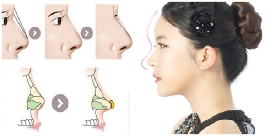 Nâng mũi S line kết hợp sụn tự thân và sụn sinh học tạo mũi đẹp hoàn hảo