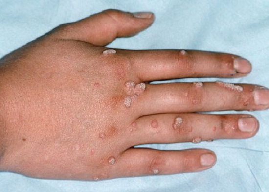 Mụn cóc có hình dạng sần sùi, dễ lây lan và thường xuất hiện nhiều ở mu bàn tay, lòng bàn chân