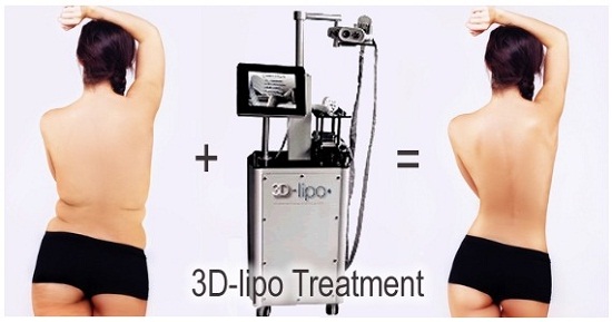 Công nghệ hút mỡ Ultra Lipo 3D