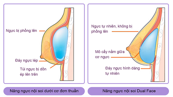 Nâng ngực nội soi Dual Face, túi ngực được đặt ở cả trước và sau cơ ngực