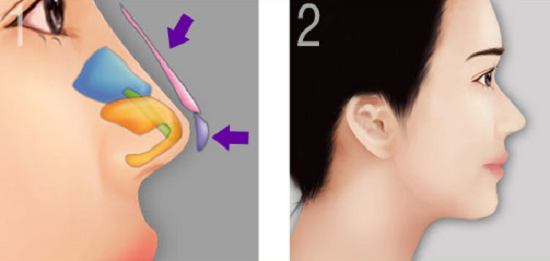 Nâng mũi bọc sụn vành tai ở đầu mũi