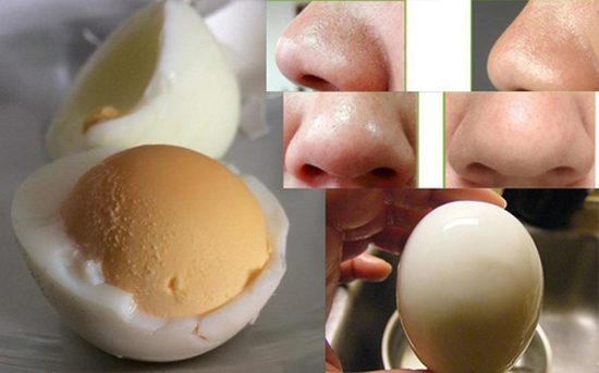 Cách trị mụn đầu đen hiệu quả nhất bằng trứng gà luộc