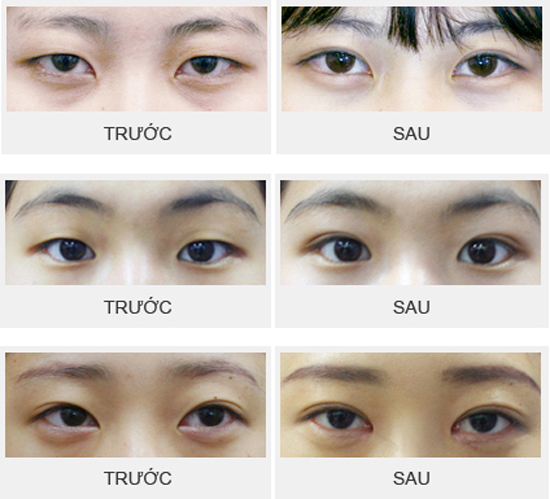 Bấm mí mắt có ảnh hưởng đến thị lực như bạn vẫn nghĩ?