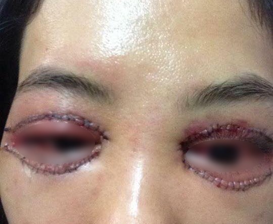tác hại của cắt mí mắt 1