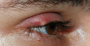 cách chữa mí mắt bị sưng 6