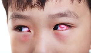 cách chữa mí mắt bị sưng 7