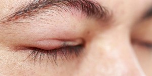 cách chữa mí mắt bị sưng 8