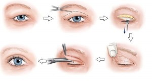 Tổng hợp các cách phẫu thuật thẩm mỹ mí mắt hiệu quả nhất hiện nay 3