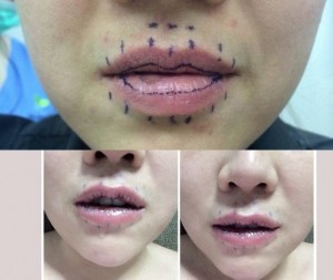 Phẫu thuật làm mỏng môi có phải tháo chỉ không? 3