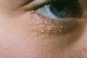 Mọc mụn trắng ở mí mắt là bệnh gì, cách chữa như thế nào? 1