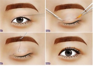 Sự khác nhau giữa bấm mí mắt và cắt mí mắt Hàn Quốc 2
