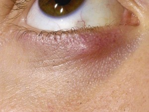 Mọc mụn trắng ở mí mắt là bệnh gì, cách chữa như thế nào? 2