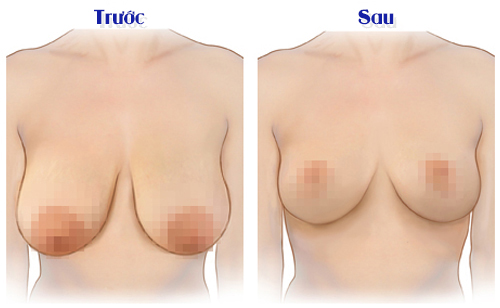 Hỏi – Đáp một số vấn đề thường gặp nhất khi nâng ngực sa trễ 3