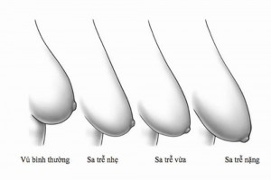 Một số điều đặc biệt quan trọng của nâng ngực sa trễ sau sinh, nâng ngực sa trễ 1