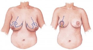 Một số điều đặc biệt quan trọng của nâng ngực sa trễ sau sinh, nâng ngực sa trễ 3